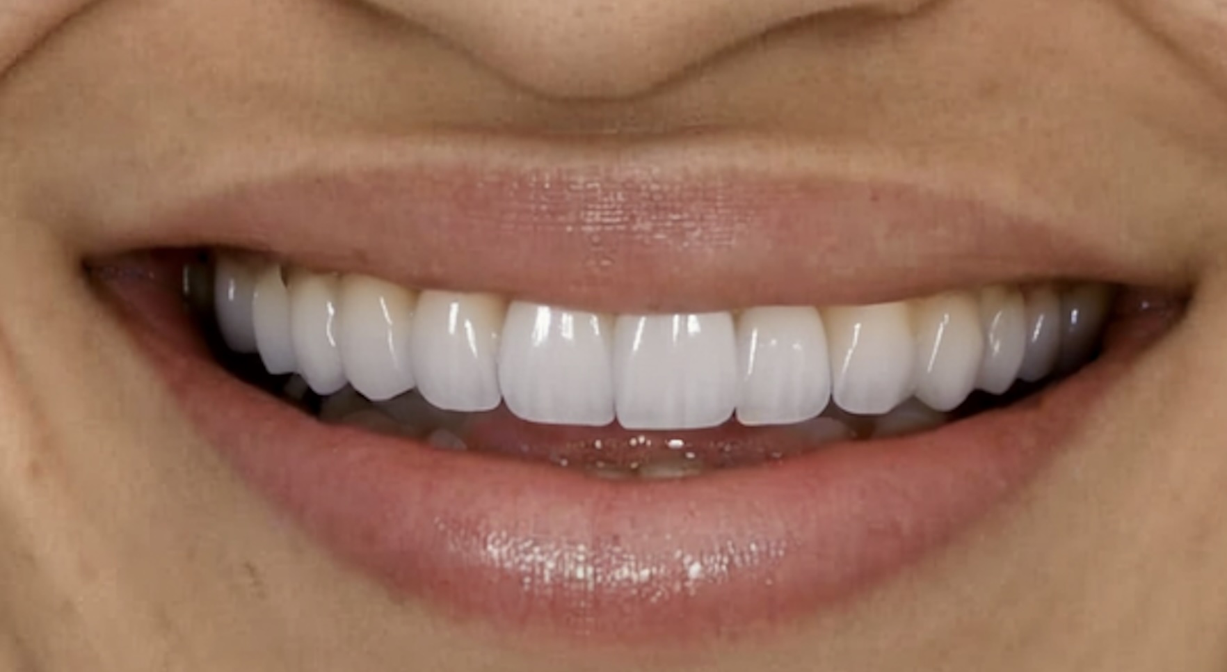 After smile transformation - close-up detail showing AI quality