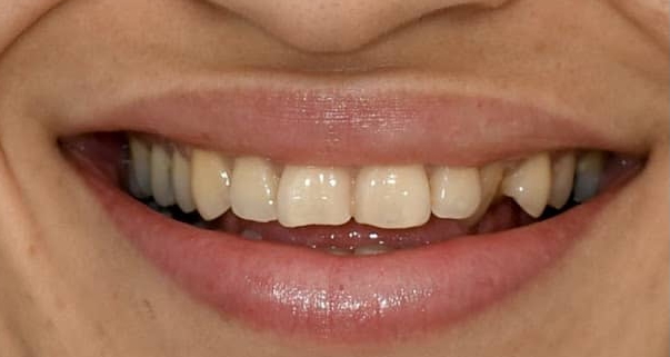 Before smile transformation - close-up detail